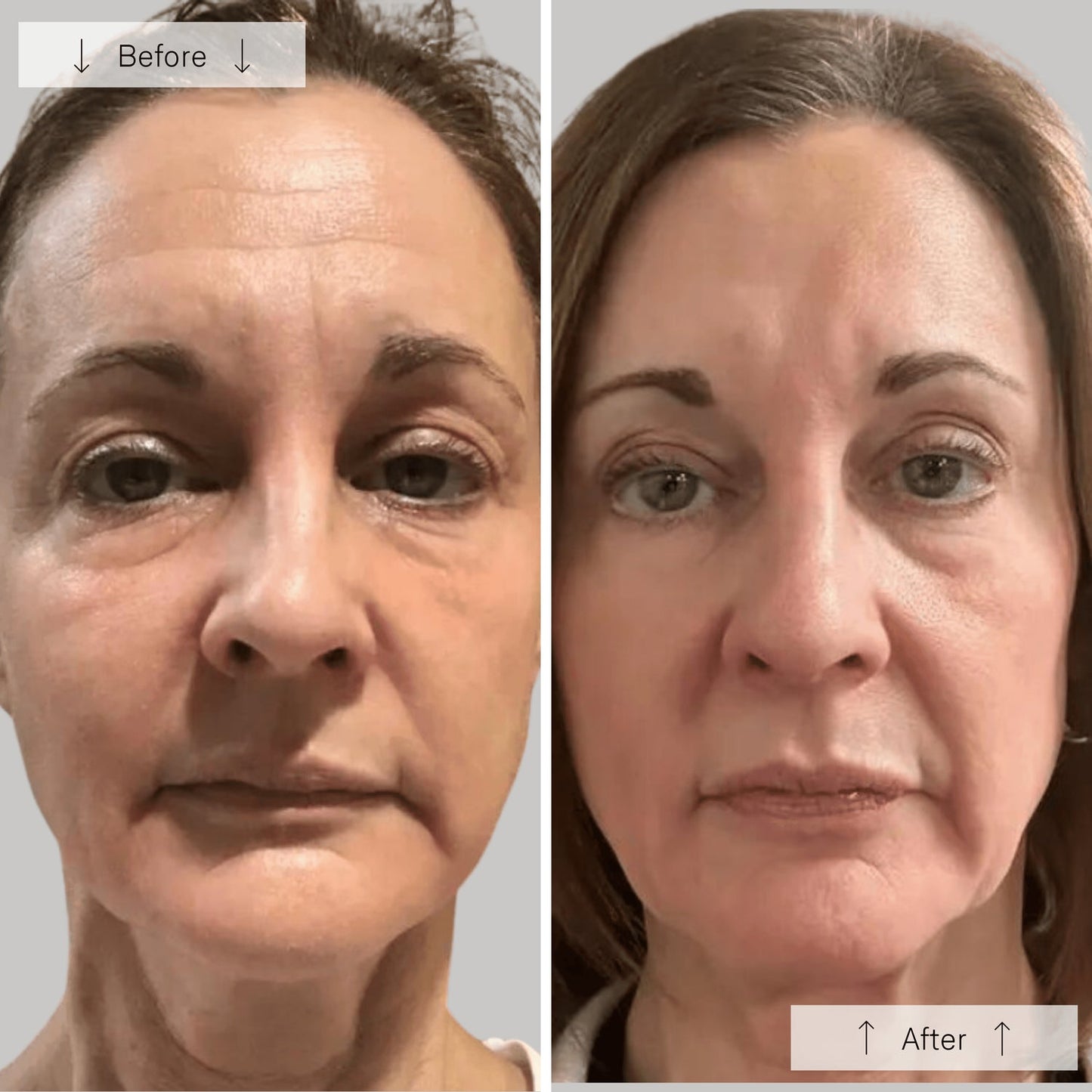 Omnilux Contour LED Face Mask
